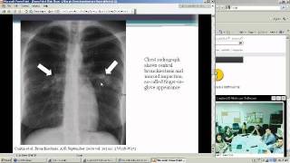 Allergic Bronchopulmonary Aspergillosis Heather Doss MD [upl. by Nahgeam]