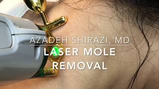 Laser Mole Removal [upl. by Halli]