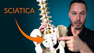 Understanding Sciatica Everything you need to know about the causes and treatment of sciatica [upl. by Ennyrb]