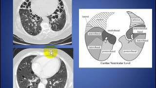 Radiology Rounds 06 Normal CT segmental Lung Anatomy [upl. by Warram]