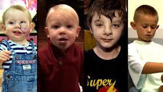 These Kids’ Lives Were Transformed by Plastic Surgery [upl. by Anoet133]