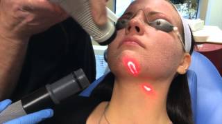 Recovery After CO2 Laser Facial [upl. by Hbahsur]