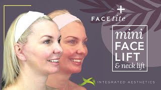 Mini facelift and neck lift using Inmode facetite device [upl. by Stratton348]