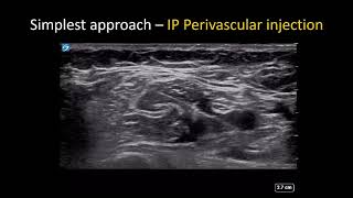 USguided Axillary Brachial Plexus Block  the Simple Guide [upl. by Ing470]