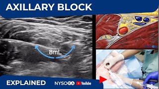 Ultrasound Guided Axillary Brachial Plexus Block NYSORA Regional Anesthesia [upl. by Rede]