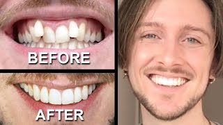 INVISALIGN REVIEW  everything you need to know [upl. by Asirak82]