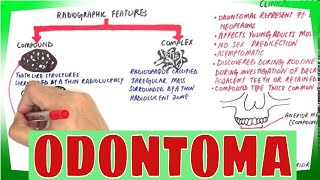 Odontoma  Types Clinical features Histopathological Features amp Treatment [upl. by Birdie477]