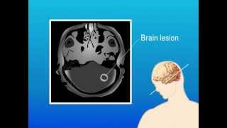 Extrapulmonary Aspergillosis – Type of Fungal Infection [upl. by Asina]