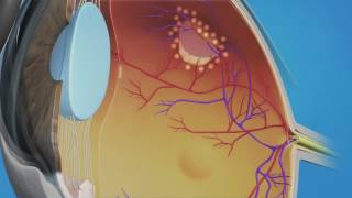 Prophylactic Laser Photocoagulation Laserpexy for Retinal Tear [upl. by Hahnert]