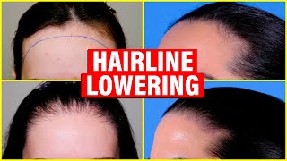 Hairline Lowering Hair Transplant vs Surgical Hairline Advancement [upl. by Annemarie]