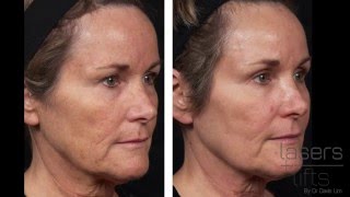 How long does it take to heal from CO2 laser resurfacing Fractional [upl. by Dell]