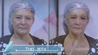 HIFU Lifting Facial  Tratamiento Tensor  Rejuvenecimiento Facial [upl. by Kasper]