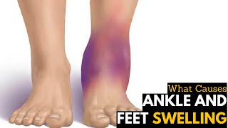 What Causes Ankles amp Feet Swelling  Diagnosis amp Treatment [upl. by Etnauj495]