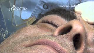 Rejuvenecimiento facial con láser [upl. by Yendic]