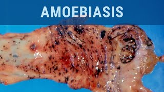 Amoebiasis  Pathology mini tutorial [upl. by Yllib]