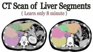 CT scan of Liver segments anatomy [upl. by Deryl807]