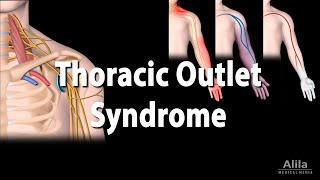 Thoracic Outlet Syndrome TOS Animation [upl. by Rhodia]