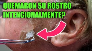 🔴 PEELING QUÍMICO Más fuerte de todos🍋 TCA  Peeling facial  PROFUNDO 🔥 [upl. by Hajar]