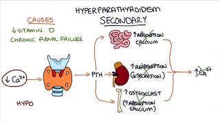 Understanding Hyperparathyroidism [upl. by Kosak]