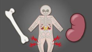 Treating XLinked Hypophosphatemia in Children [upl. by Ardys]