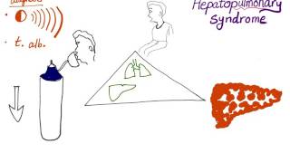 Hepatopulmonary syndrome the clinical triad [upl. by Akihdar584]