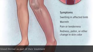 Isolated Calf Vein Thrombosis DVT Below the Knee [upl. by Eceinehs]