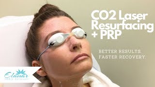 CO2 Laser Skin Resurfacing  PRP  Better Results and Faster Recovery [upl. by Llekcm183]