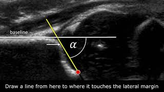 Developmental Dysplasia of the Hip  Ultrasound [upl. by Aik]