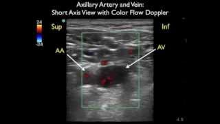 How To Axillary Vein Cannulation  Sonosite Ultrasoundmp4 [upl. by Mossman210]